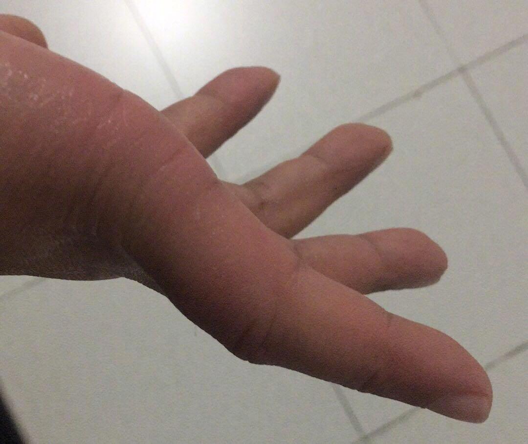被蜈蚣咬伤了该怎么急救处理