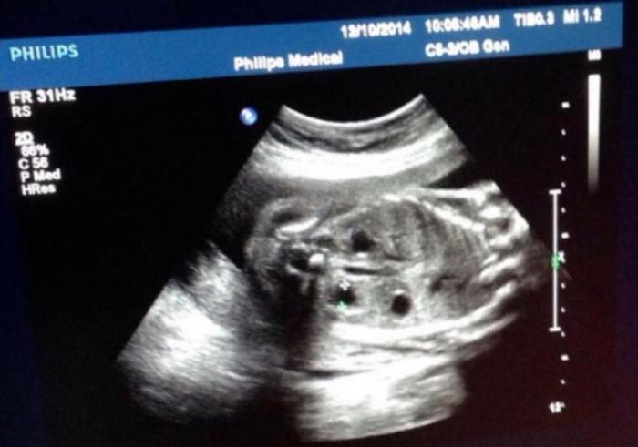 怀孕四个月宝宝B超能看出胎儿的性别吗?|