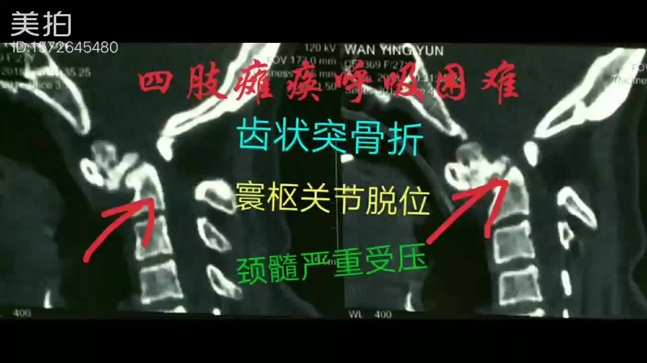 查颈椎磁共振提示寰枢关节脱位,颈髓受压明显.