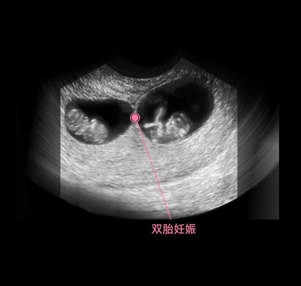 胎儿从卵泡到孕17周，17张图片清晰诠释，男宝女宝看得很清楚