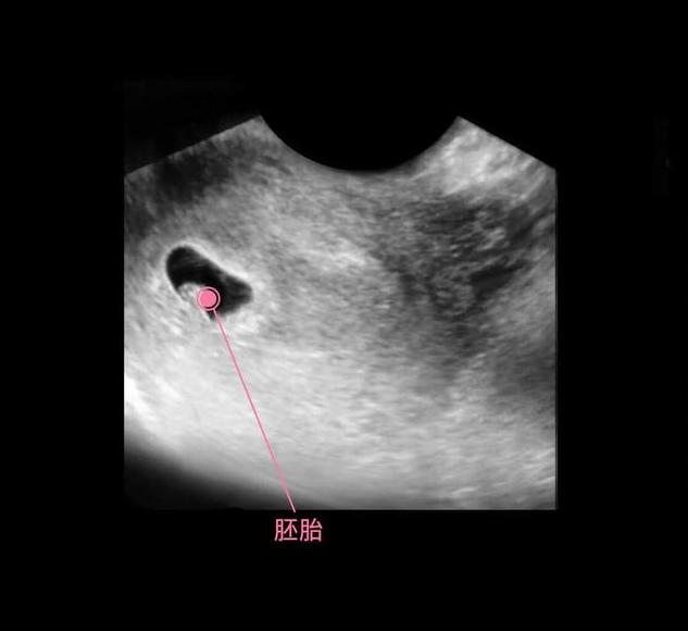 胎儿从卵泡到孕17周，17张图片清晰诠释，男宝女宝看得很清楚