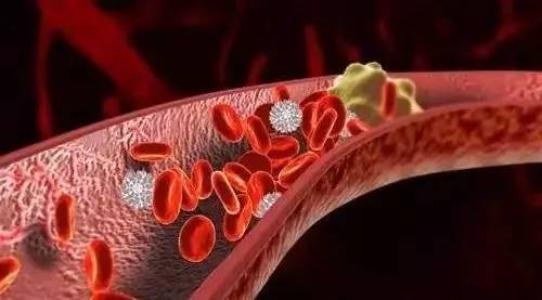 什么是静脉血栓?静脉血栓好治疗吗?