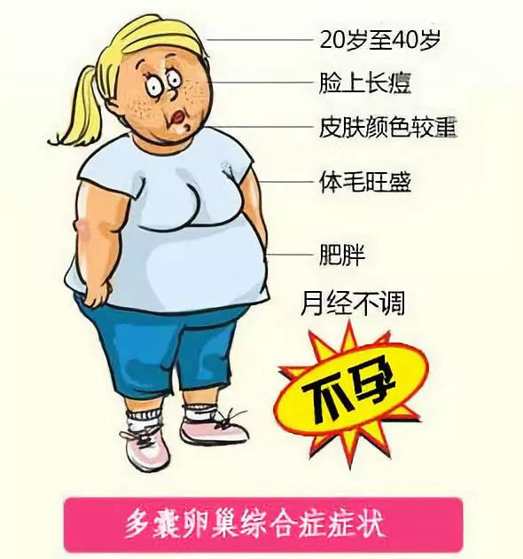 多囊卵巢综合征