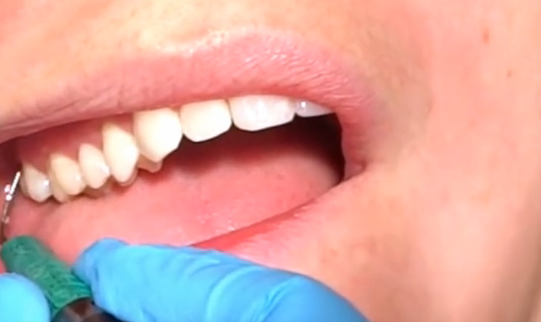 有了牙结石怎么办?不用上医院,自己在家也能轻