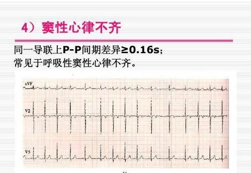 体检报告里面的窦性心律是什么意思?|心律|窦