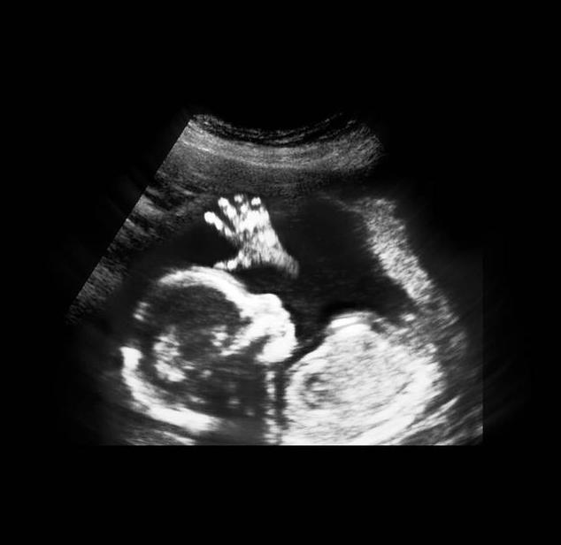 胎儿从卵泡到孕17周，17张图片清晰诠释，男宝女宝看得很清楚