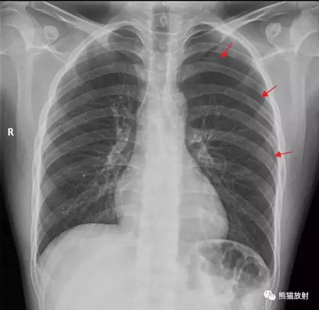 气胸时如何大体判断肺被压迫的程度?