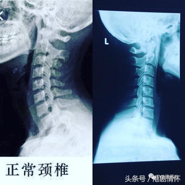 夏薇於6月上传这张x光片,表示自己的颈椎出现问题,而要放病假.