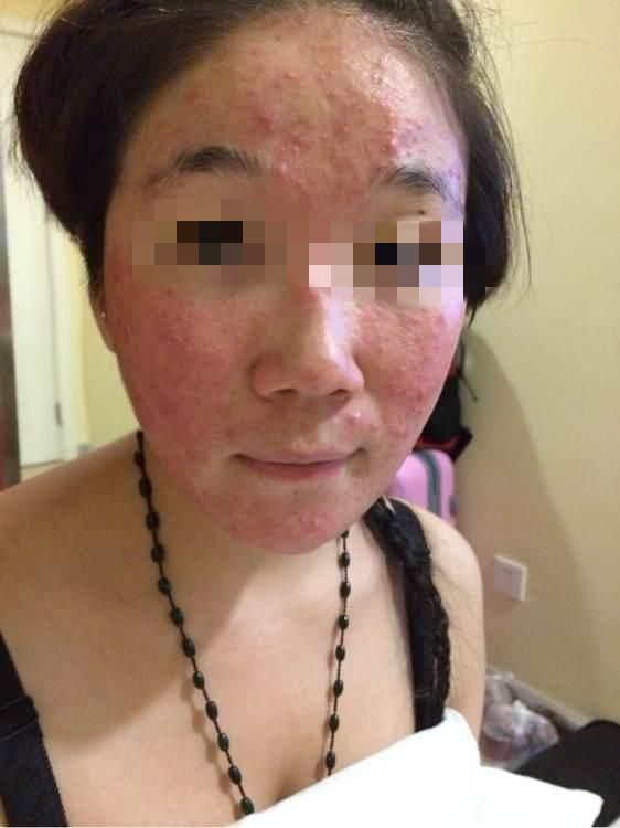 先搞清楚激素依赖性皮炎的发病机理