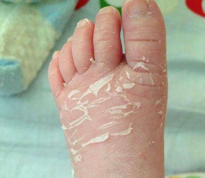 15天婴儿皮肤脱皮,宝妈嫌难看帮孩子撕掉,结果亲手毁