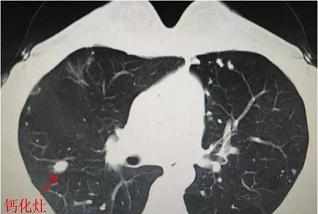 右肺上叶结节钙化灶是什么意思?会不会恶化?