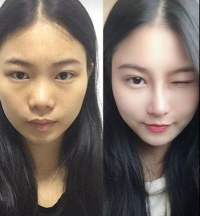 朱洪涛自体肋软骨隆鼻你了解多少