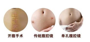 腹腔镜手术不是微创手术吗？为什么还要全身麻醉？很多人都搞错了