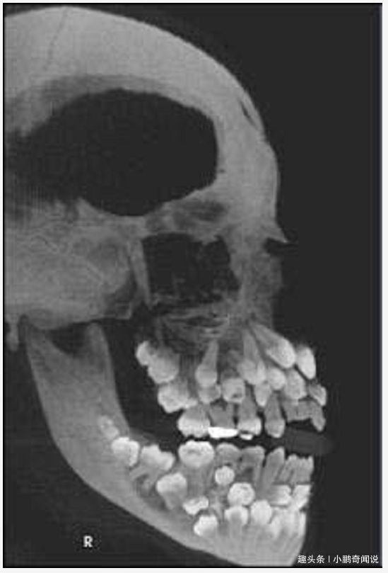 8岁男孩嘴里长上百颗牙齿,x光拍出来的照片不忍直视!