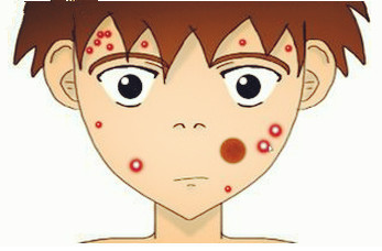 奥络夫西地酸乳膏帮你告别痘痘