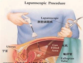 腹腔镜手术不是微创手术吗？为什么还要全身麻醉？很多人都搞错了