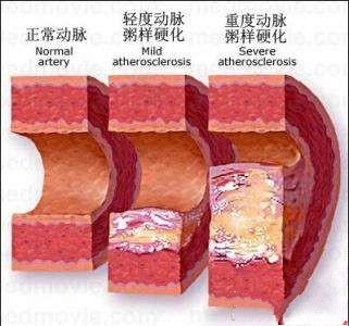 冠状动脉硬化可确定冠心病吗?医生解释具体原
