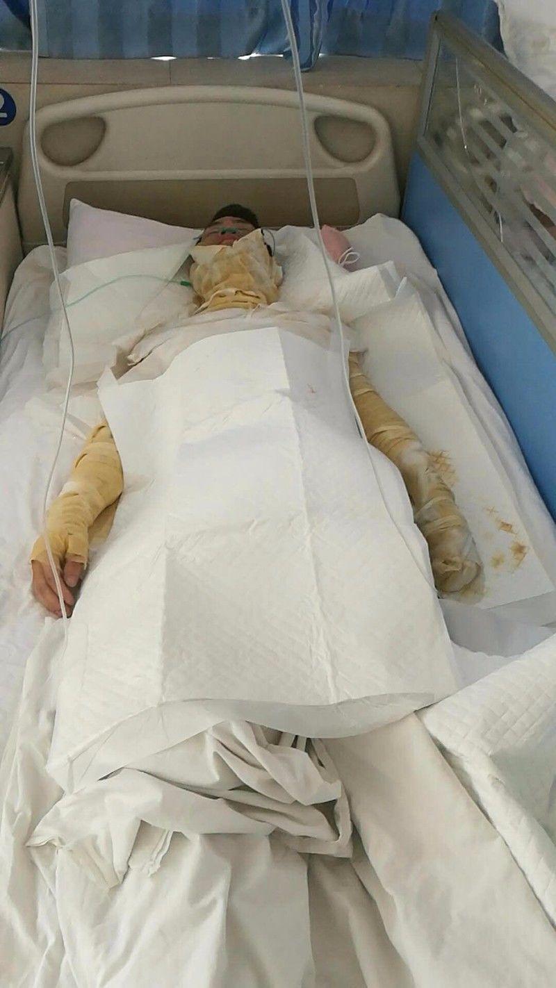 遵义男子全身30%被香蕉水烧伤,不能这么做