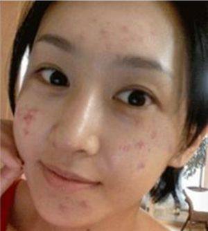 脸上长痘了怎么办?原来之前方法都错了 脸上长痘了怎么办?原来之前方法都错了