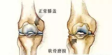 年轻人也会得的老年病--膝骨关节炎