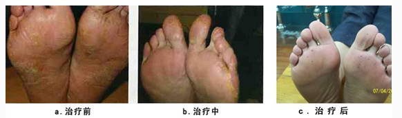 严重的脚气怎么根治 15年脚气如今终于解脱