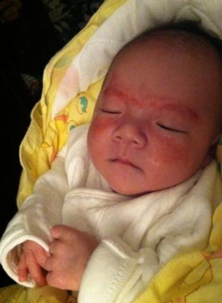 婴儿湿疹逐渐蔓延如何治愈!