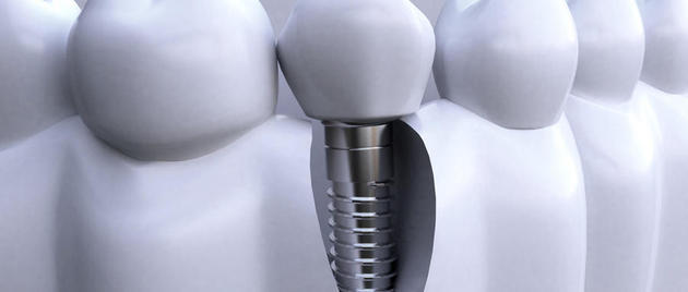 还有这么赚钱的行业：口腔器械掘金 “种一口牙等于买一辆宝马”