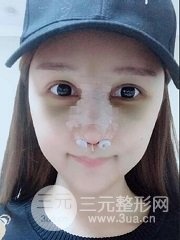耳软骨垫鼻尖隆鼻过程分享及术后照片