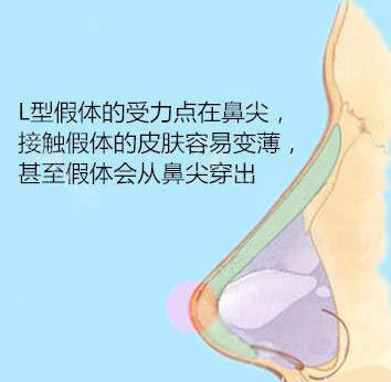 从单纯隆鼻到复合隆鼻再到鼻综合整形，原来没选对隆鼻方式真的会变丑