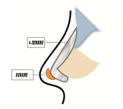 从单纯隆鼻到复合隆鼻再到鼻综合整形，原来没选对隆鼻方式真的会变丑