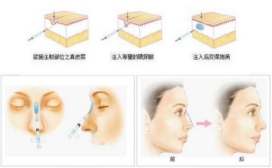 从单纯隆鼻到复合隆鼻再到鼻综合整形，原来没选对隆鼻方式真的会变丑