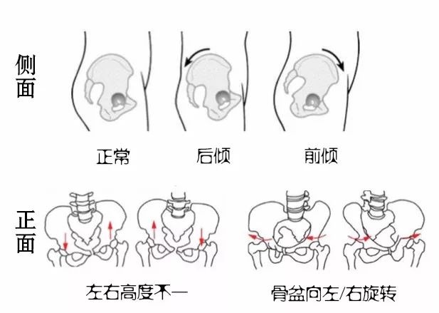 这主要是由于肌肉力量不平衡造成骨盆的角度改变,并非骨骼本身变形.