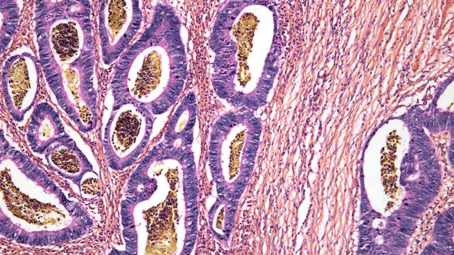 结肠癌细胞。STEVE GSCHMEISSNER/SCIENCE SOURCE