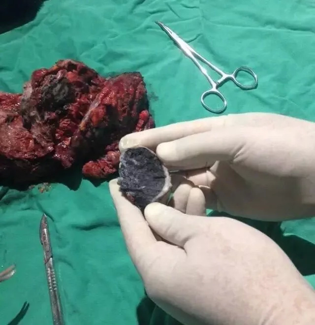 600万尘肺病人，怎么招募240个患者就这么难?