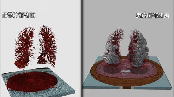 3d呈现新冠患者肺部影像