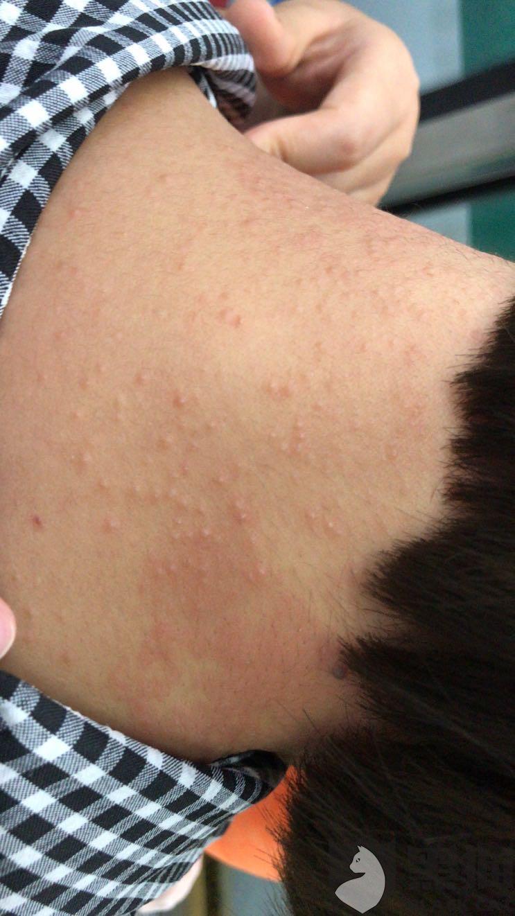 仅脖子过敏,是耳机造成的,后京东客服致电,本人要求给我产品质检报告