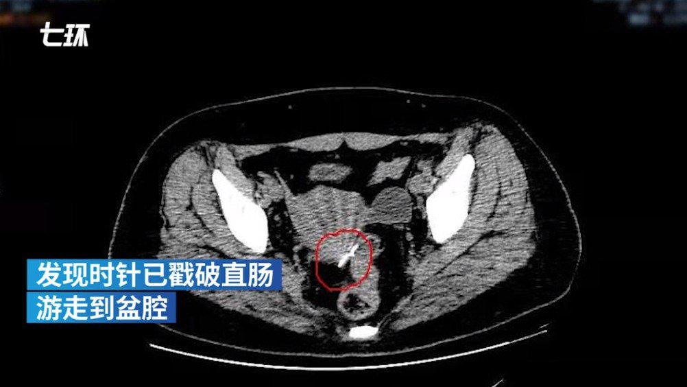 女子腹内藏针30年无感：已游走至盆腔且腐蚀严重