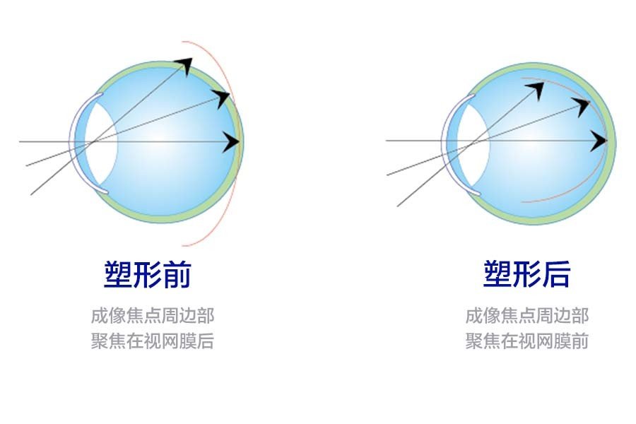 怎么买库博佰视明散光,库博佰视明散光哪里买