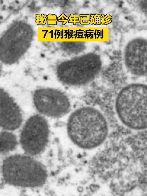 秘鲁今年确诊71例猴痘病例