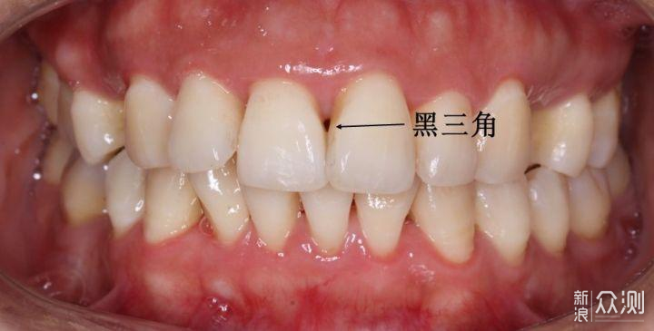 衝牙器被小米玩出花了:米家電動衝牙器F300_新浪眾測