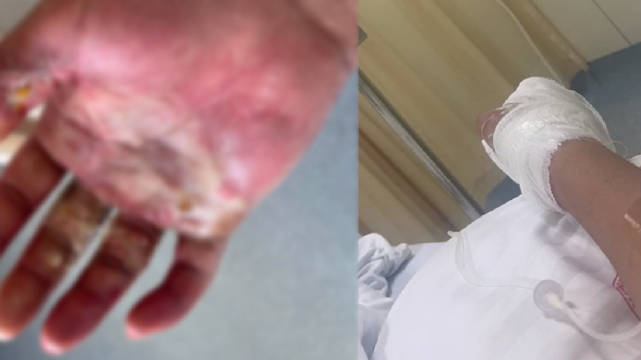 小伙上班6天误触辐射源