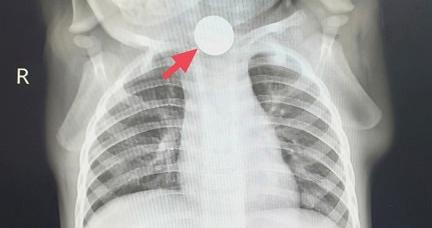 一岁宝宝厌食一周，竟是硬币卡喉！医生提醒：这些生活细节隐患需警惕！