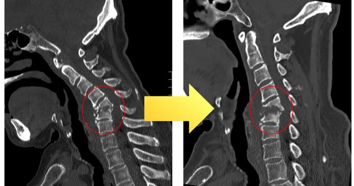 宁波大爷脖子肩膀反复酸麻，确诊脊柱感染！颈椎两节骨头被悄悄“吃空”，医生：再发展下去，随时可能瘫痪