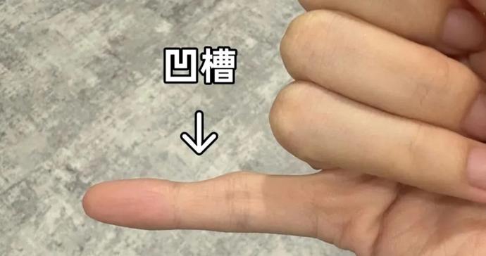 小指不直有凹陷,竟是这个习惯造成的?上海中山医院自创“手指操”告别手机手 小指不直有凹陷,竟是这个习惯造成的?上海中山医院自创“手指操”告别手机手