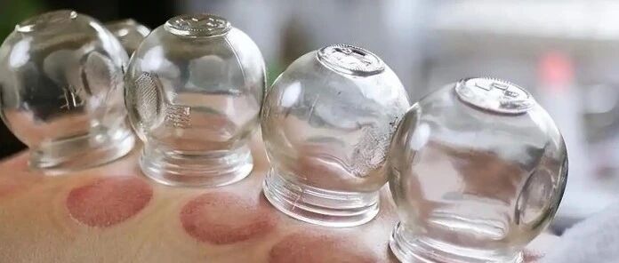 足疗店拔罐变“噩梦”,女子二度烧伤!酒精起火怎么办? 足疗店拔罐变“噩梦”,女子二度烧伤!酒精起火怎么办?