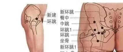新环跳七穴治疗坐骨神经痛,腰腿痛 新环跳七穴治疗坐骨神经痛,腰腿痛
