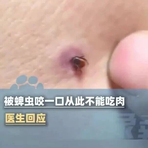“被蜱虫咬一口从此不能吃肉”登上热搜 “被蜱虫咬一口从此不能吃肉”登上热搜