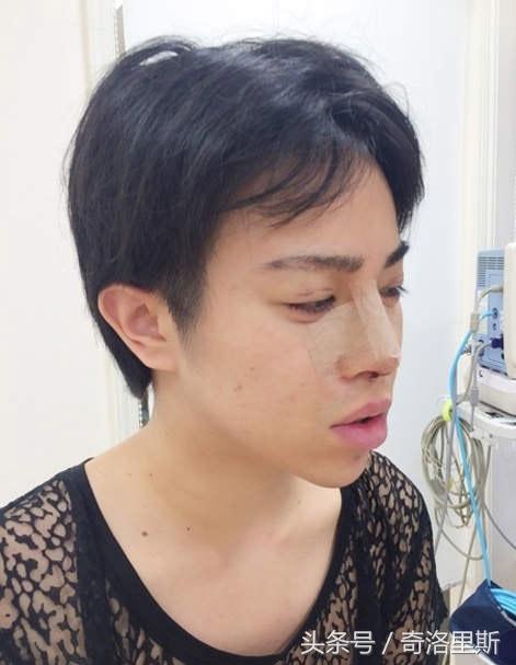 Allen还接受了隆鼻手术。