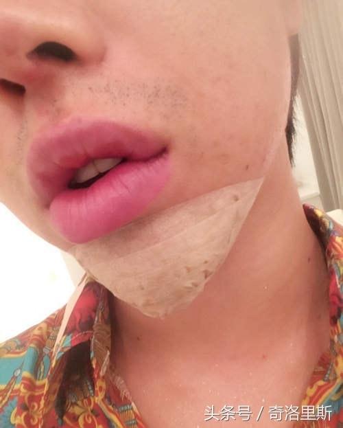 Allen整形的费用全靠女生援助,图为他刚削骨的样子。