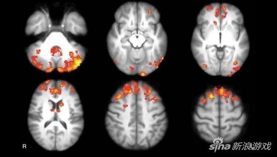 新研究:玩电子游戏可治疗脑部疾病